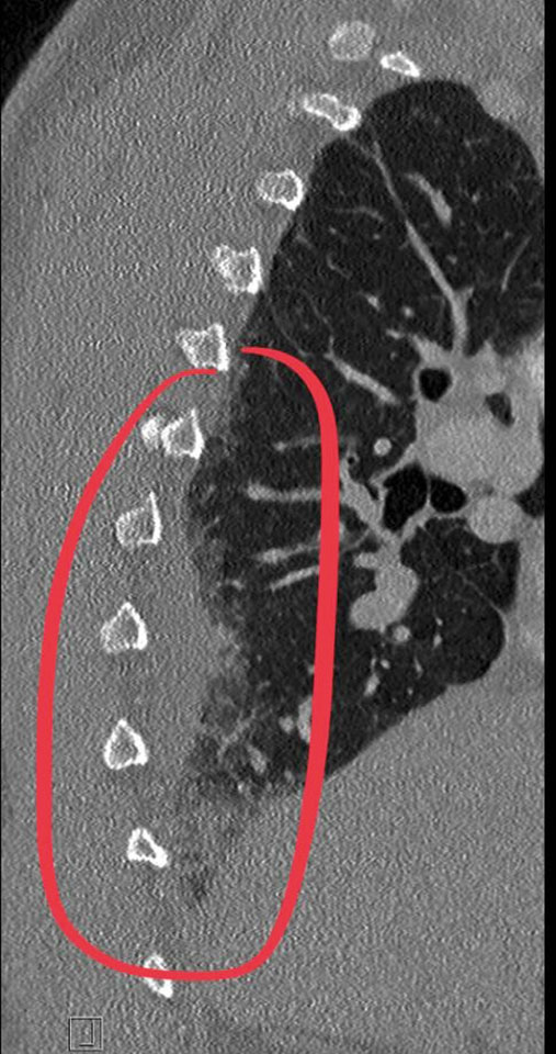 Röntgenbild - Thrombose beim Motorradfahren