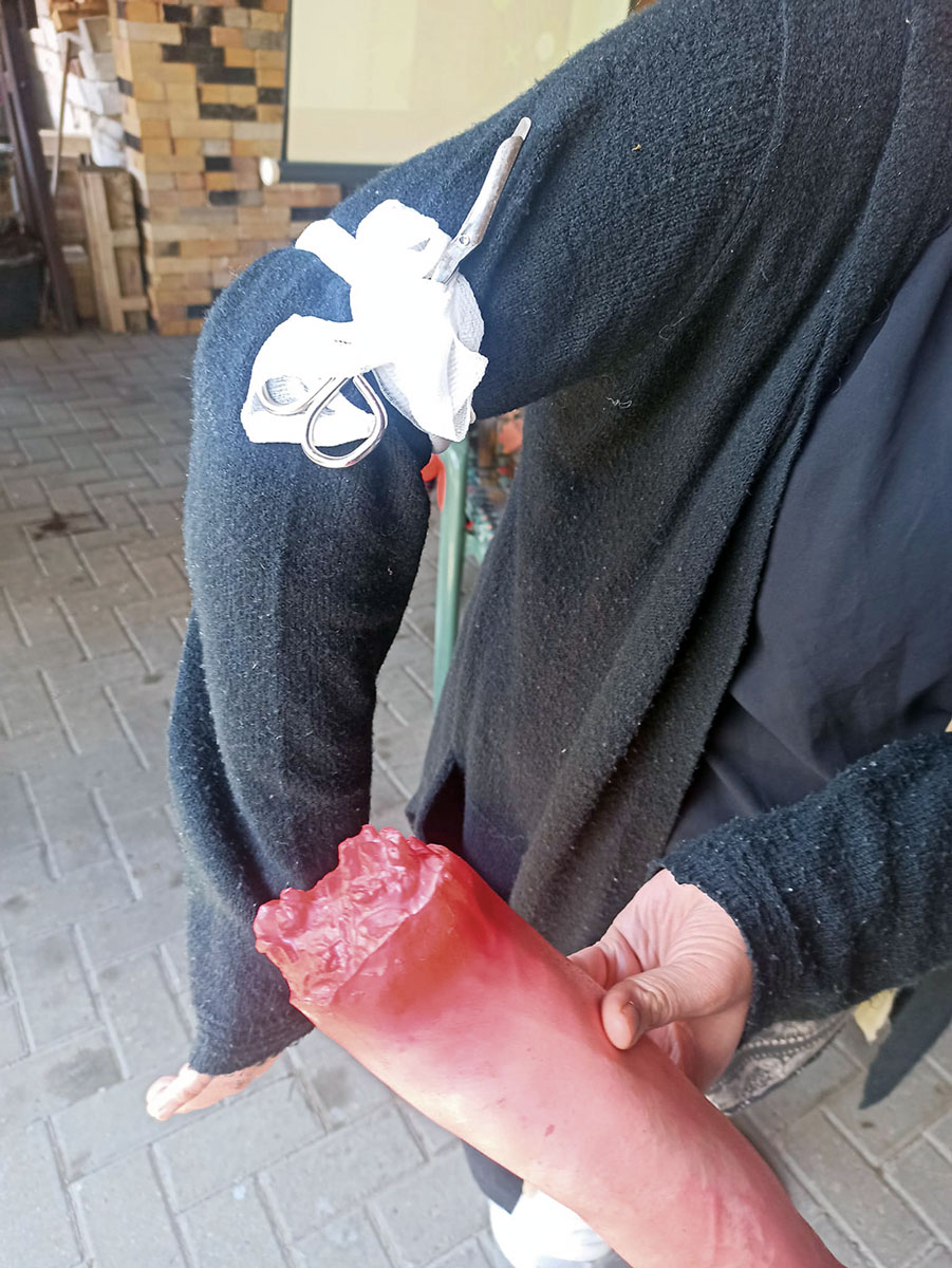 Arm ab? Wie jetzt abbinden? Arm ab? Wie jetzt abbinden?